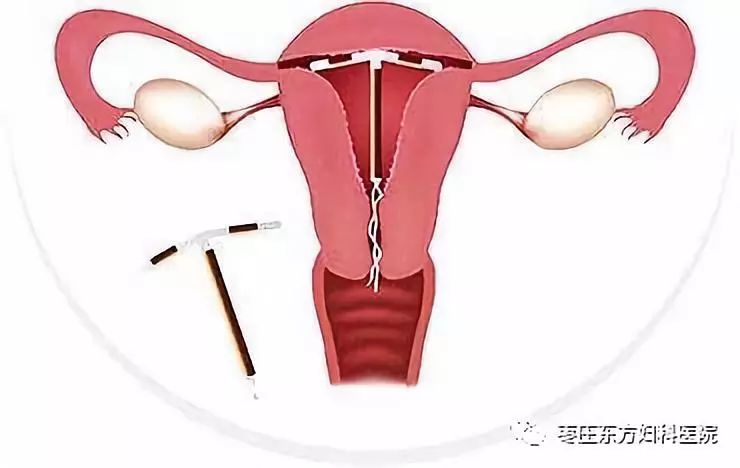 去医院上曼月乐环应该挂什么科（上曼月乐挂妇科还是计划生育科）